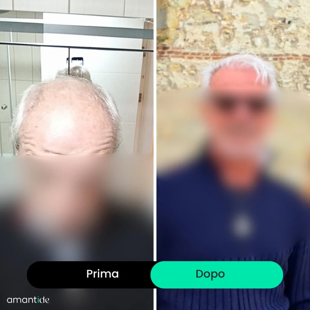TRAPIANTO CAPELLI TURCHIA RISULTATI
