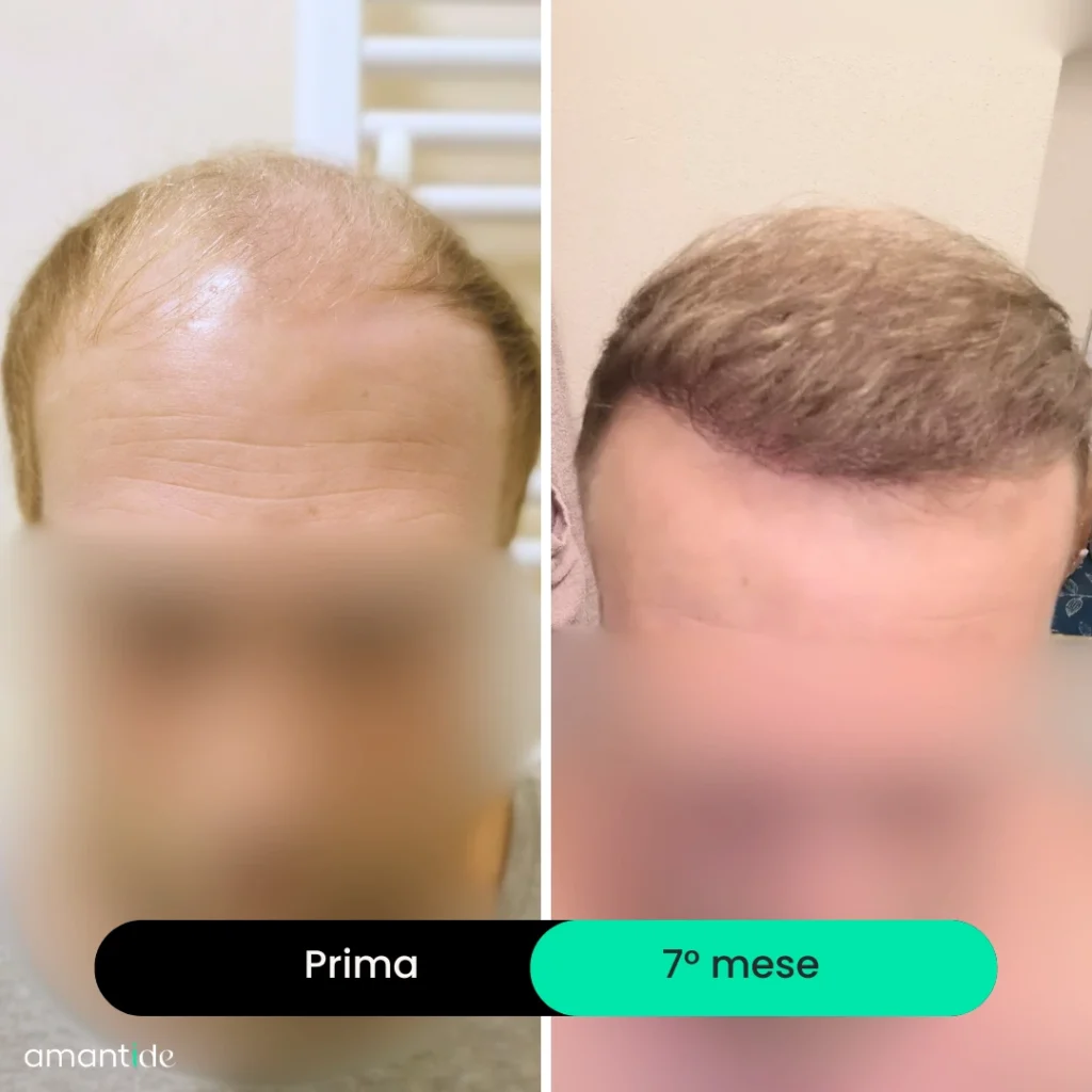 trapianto di capelli in turchia prima e dopo