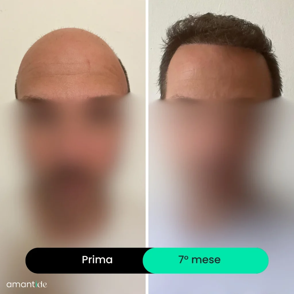trapianto di capelli in turchia prima e dopo_1