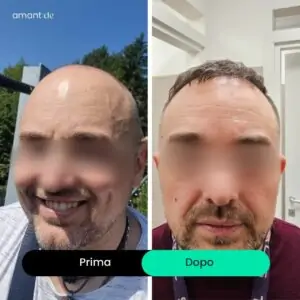 Trapianto capelli prima e dopo