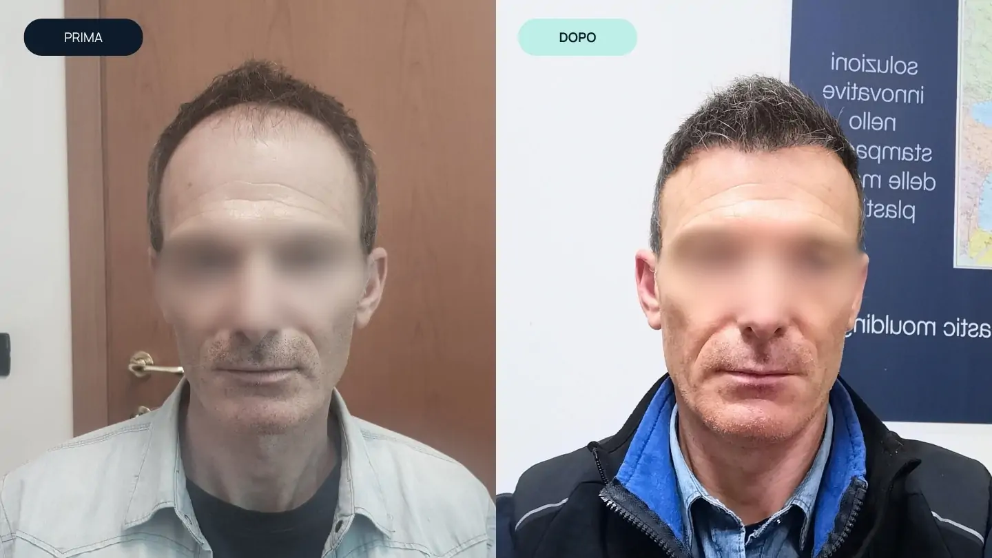 prima e dopo 4 | amantide | trapianto capelli | cura del capello