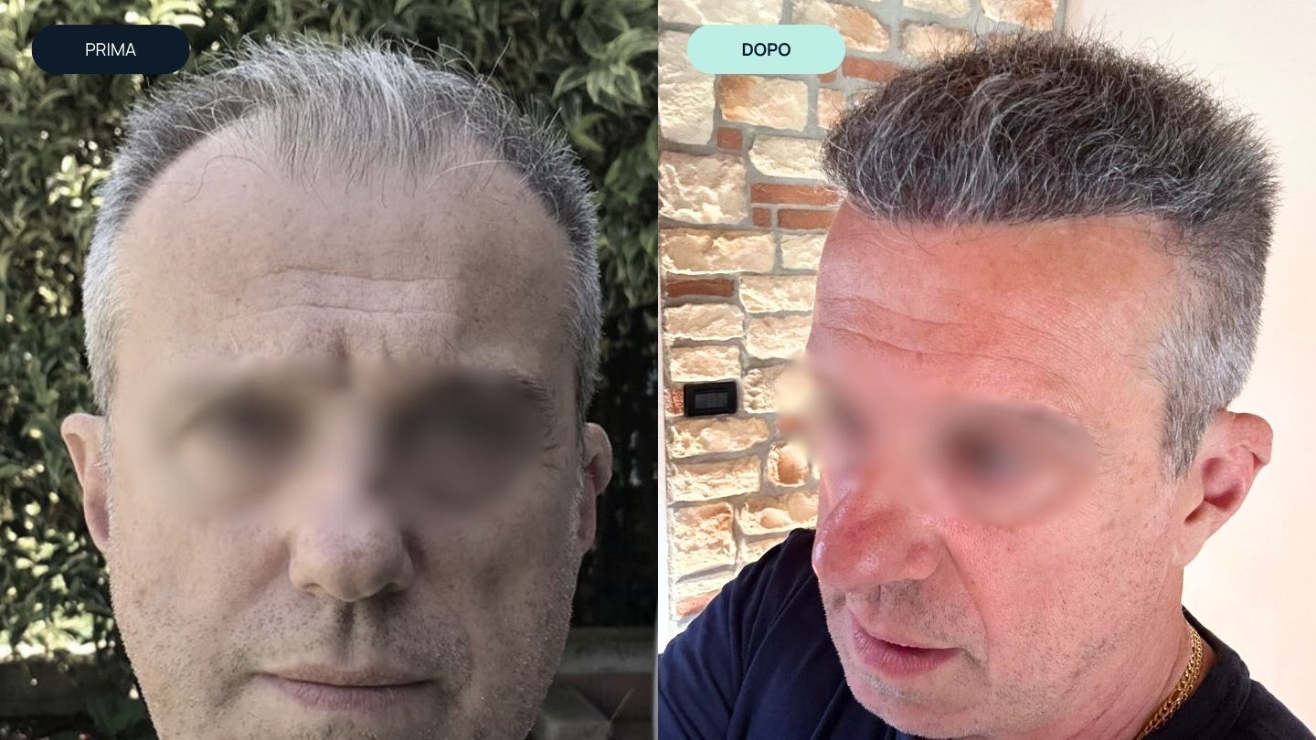 prima e dopo 3 | amantide | trapianto capelli | cura del capello