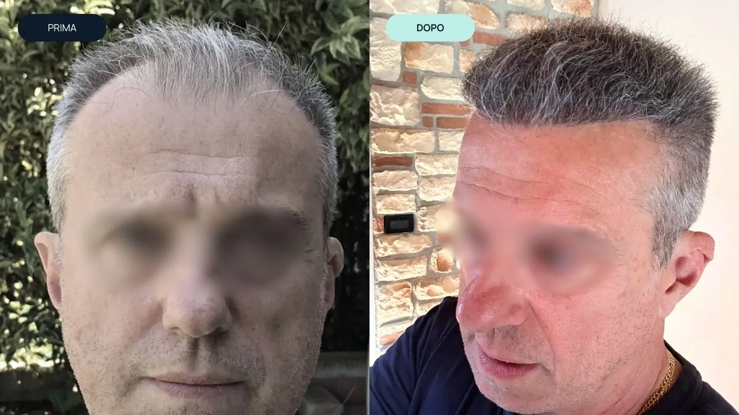 prima e dopo 3 | amantide | trapianto capelli | cura del capello