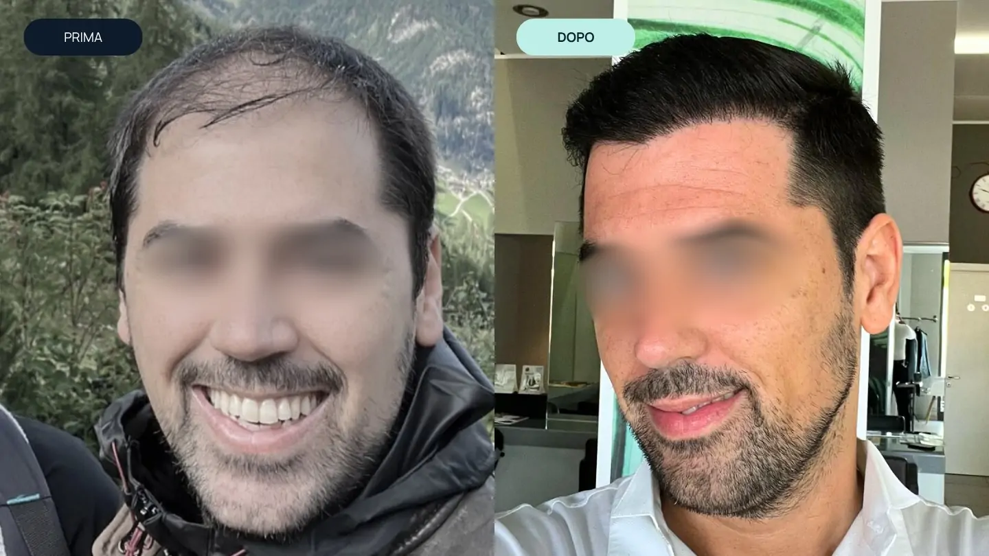 prima e dopo 2 | amantide | trapianto capelli | cura del capello