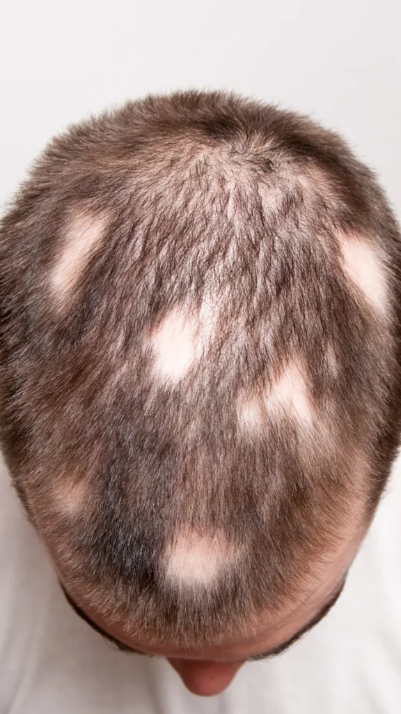 alopecia areata | come si manifesta | amantide