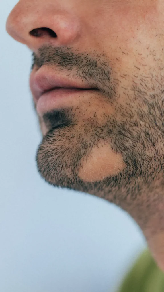 l'impatto emotivo dell'alopecia areata | amantide