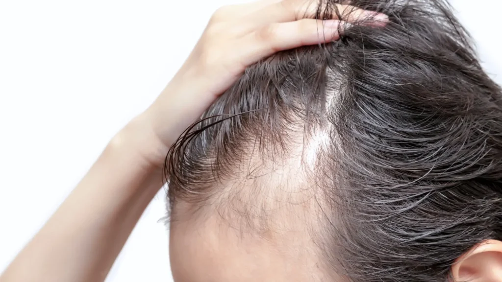 alopecia androgenetica | amantide