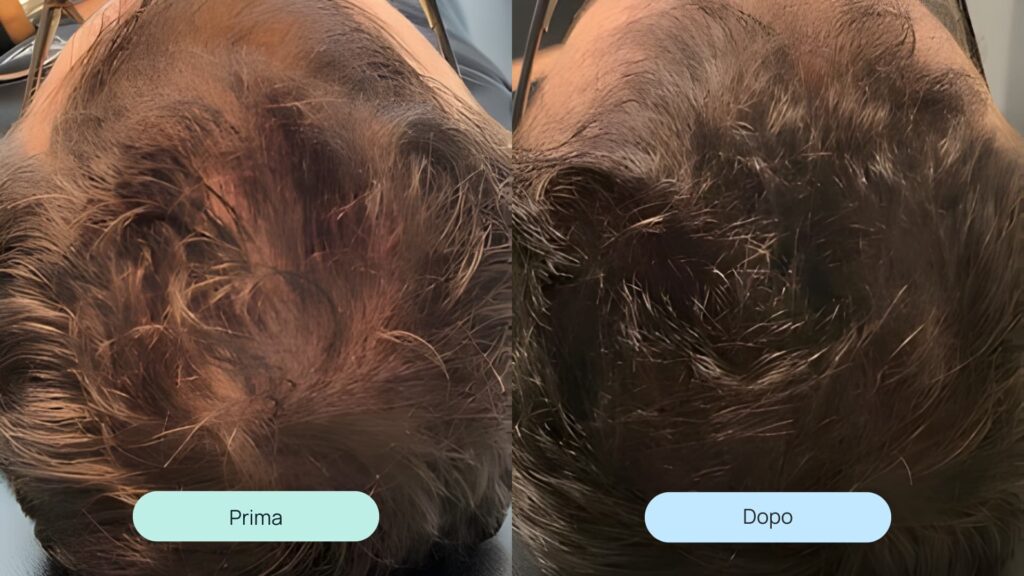 cellule staminali per capelli | cosa aspettarsi | amantide