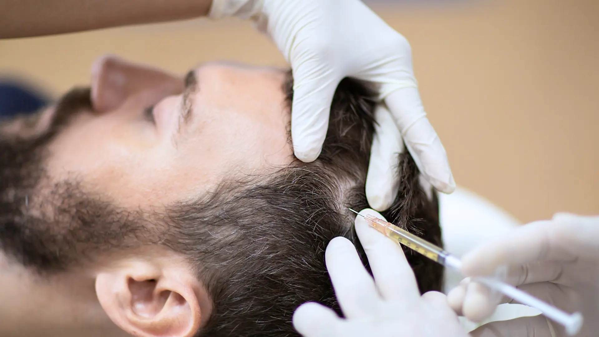 PRP capelli procedura