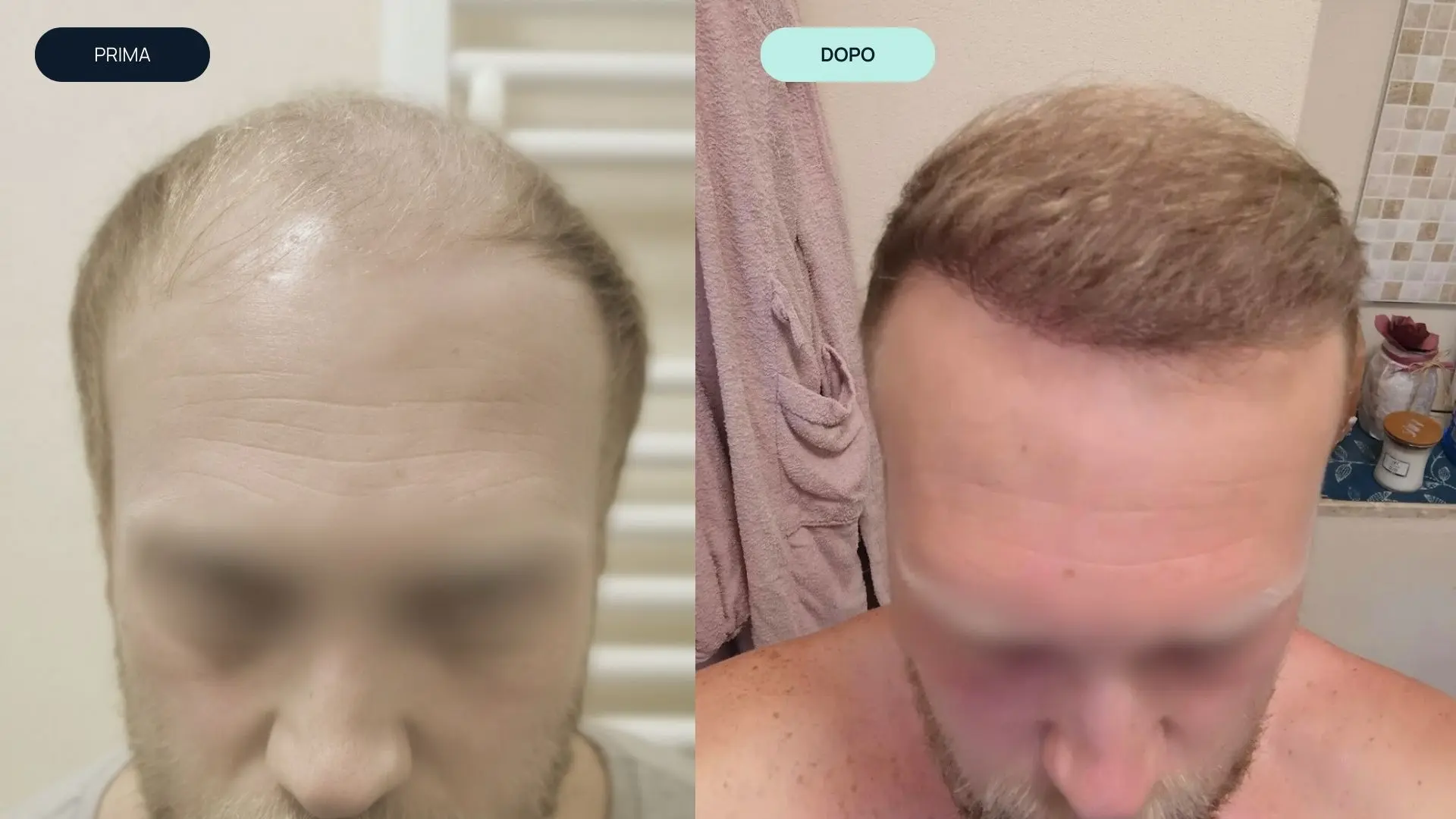 prima e dopo 1 | amantide | trapianto capelli | cura del capello