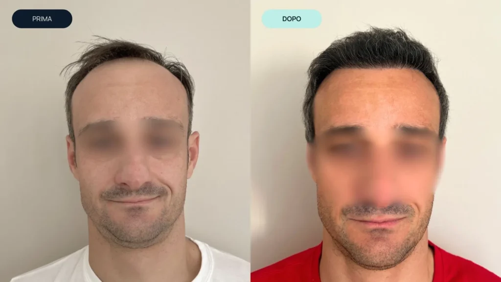 prima e dopo 5 | amantide | trapianto capelli | cura del capello