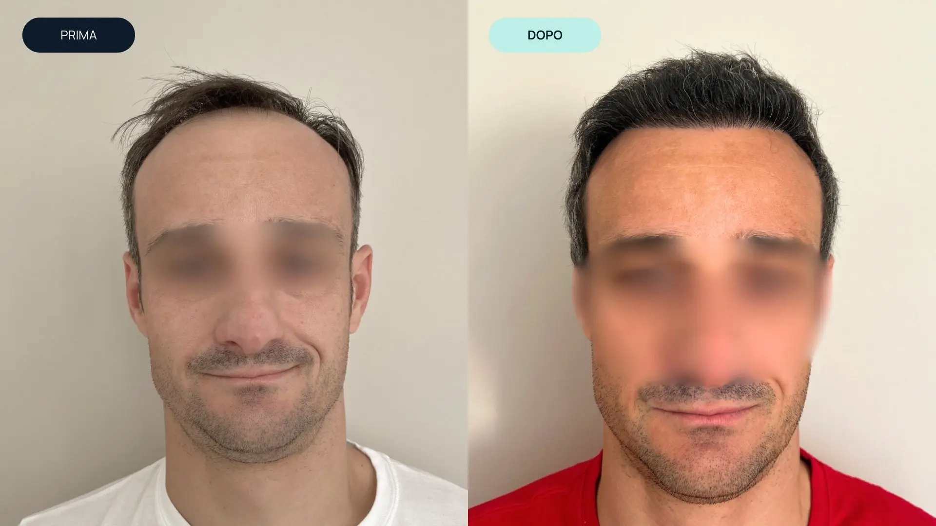 prima e dopo 5 | amantide | trapianto capelli | cura del capello