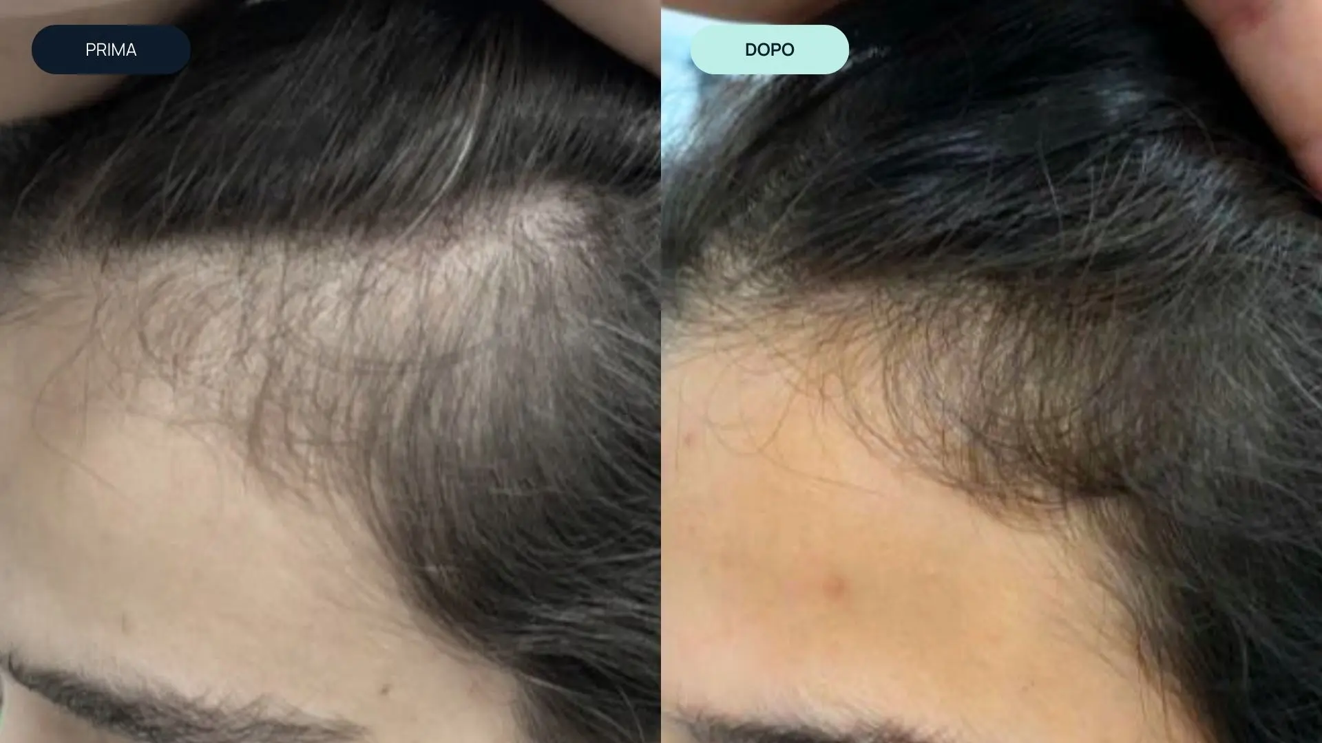 prima e dopo 7 | amantide | trapianto capelli | cura del capello