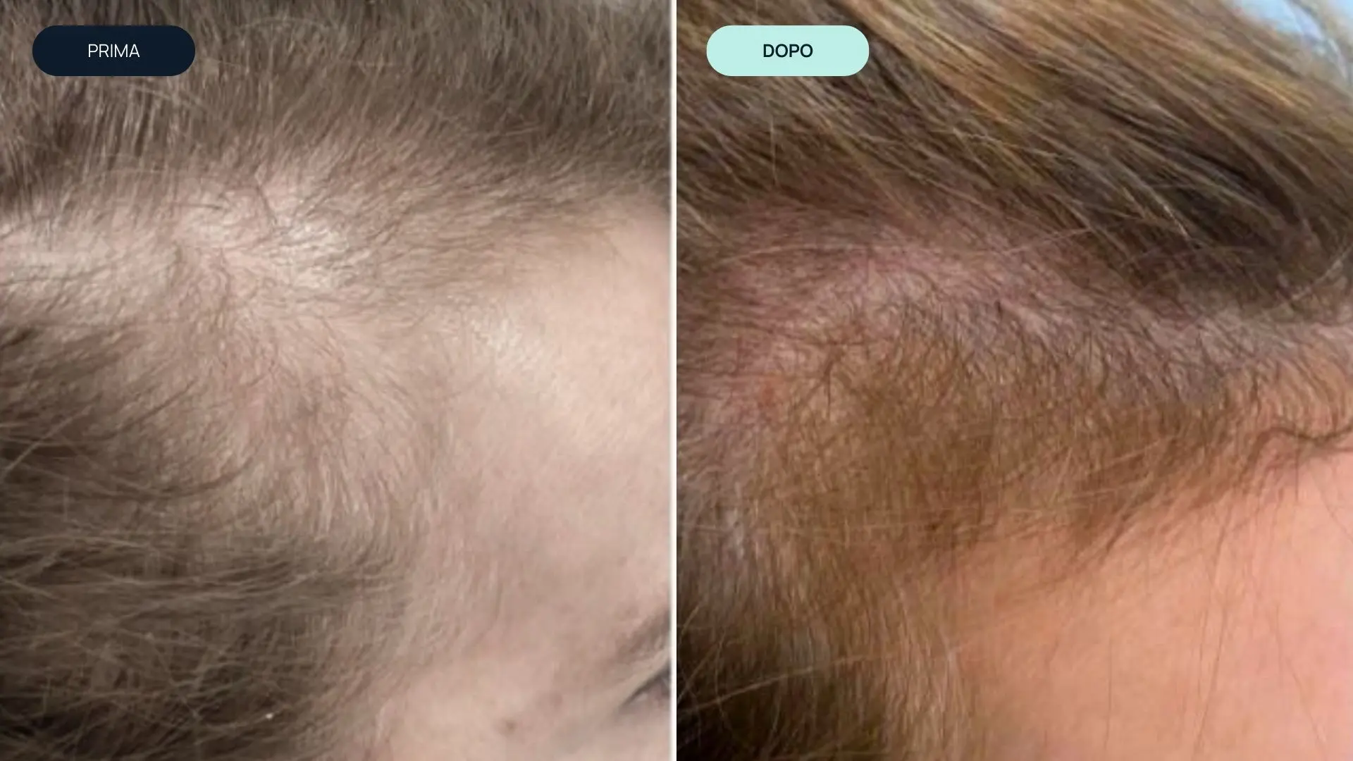 prima e dopo 8 | amantide | trapianto capelli | cura del capello