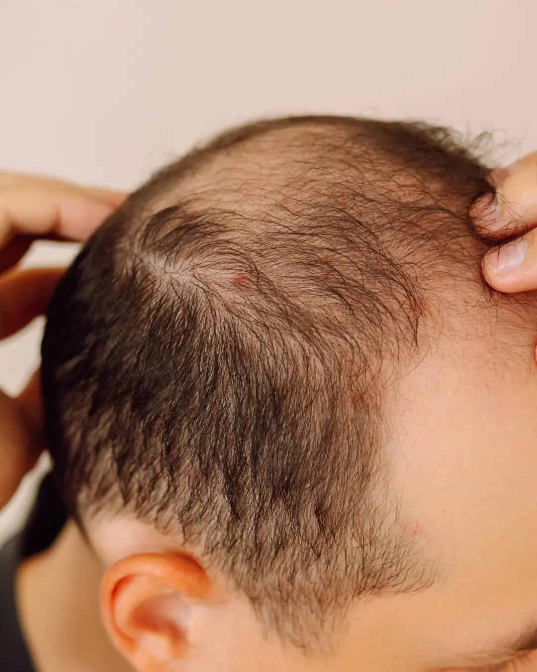 Approfondimenti caduta capelli