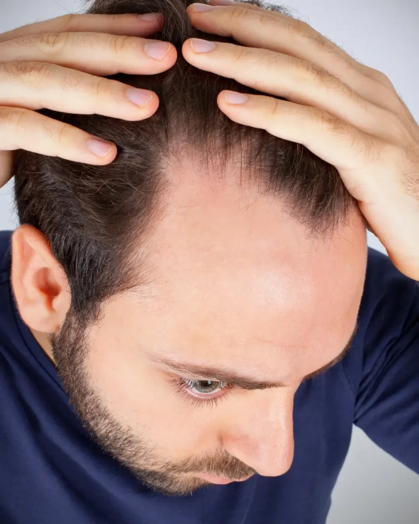 le principali cause della caduta dei capelli | amantide