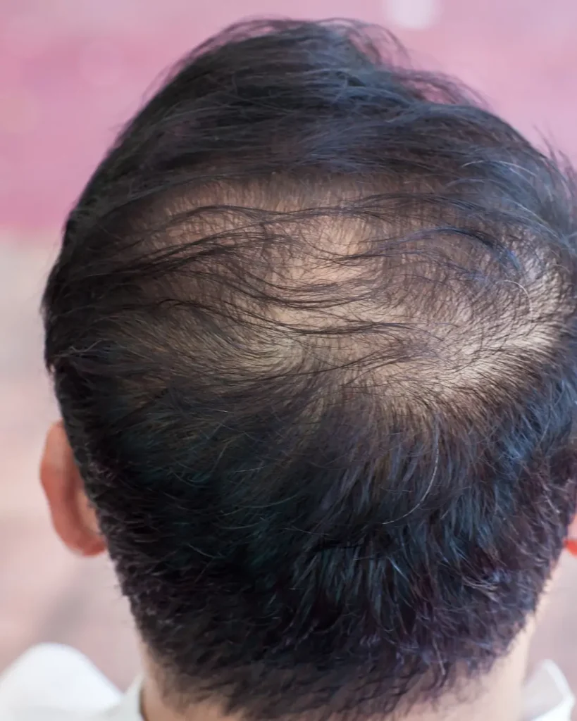 come si manifesta il diradamento capelli | amantide