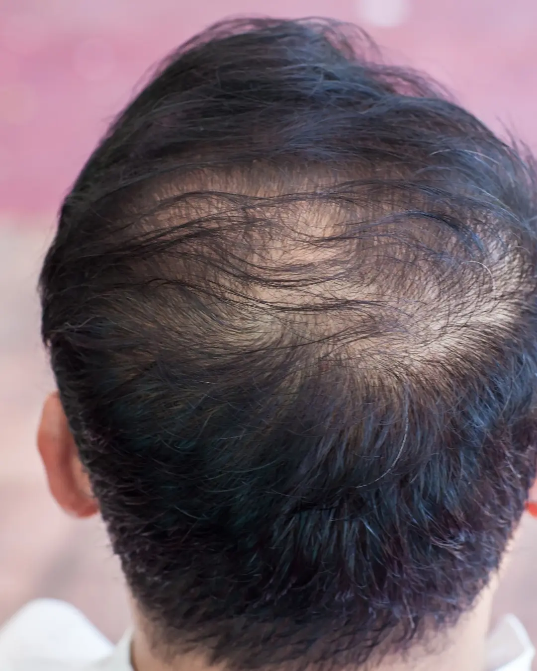 Cause diradamento capelli