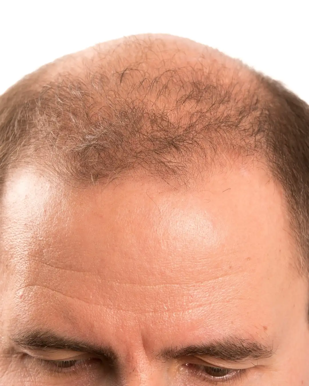 Miniaturizzazione follicolare alopecia androgenetica