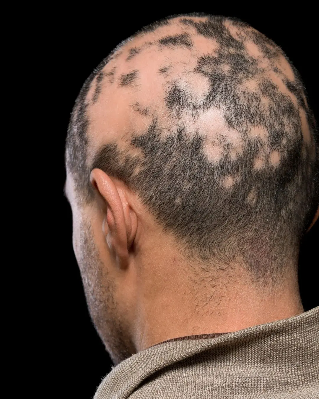 Cause alopecia areata