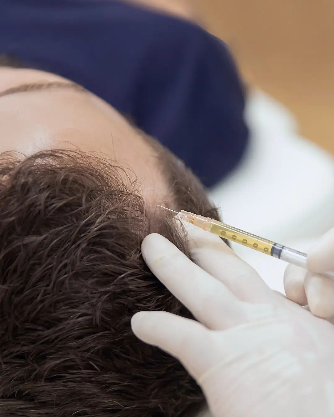 PRP capelli Amantide