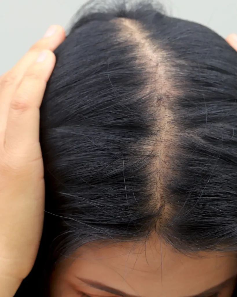 la caduta di capelli nelle donne | amantide