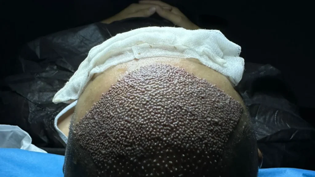 trapianto capelli albania | il ruolo di amantide