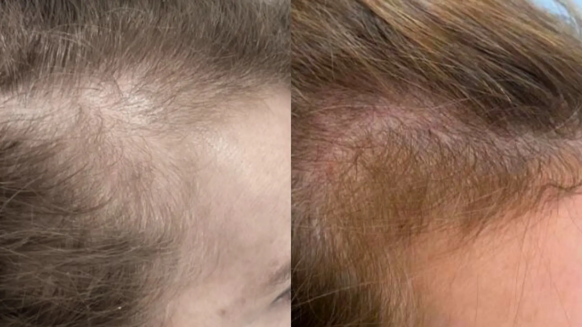 Trapianto capelli donne: funziona? Guida completa 2026