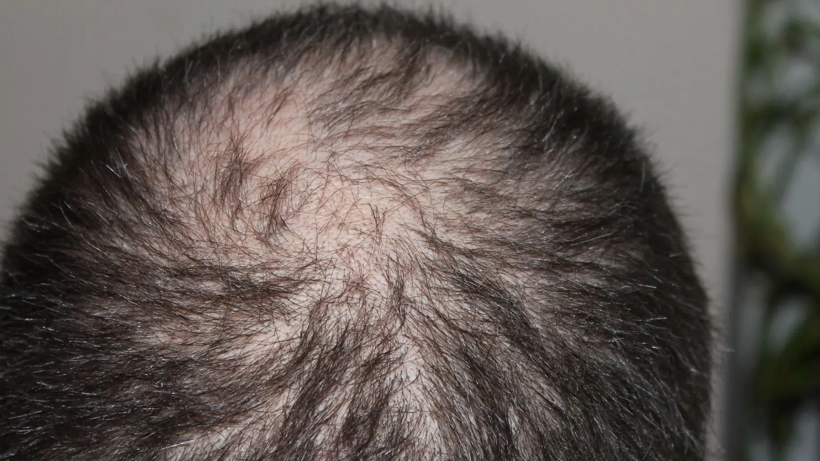 Malattie che provocano la caduta dei capelli: la lista