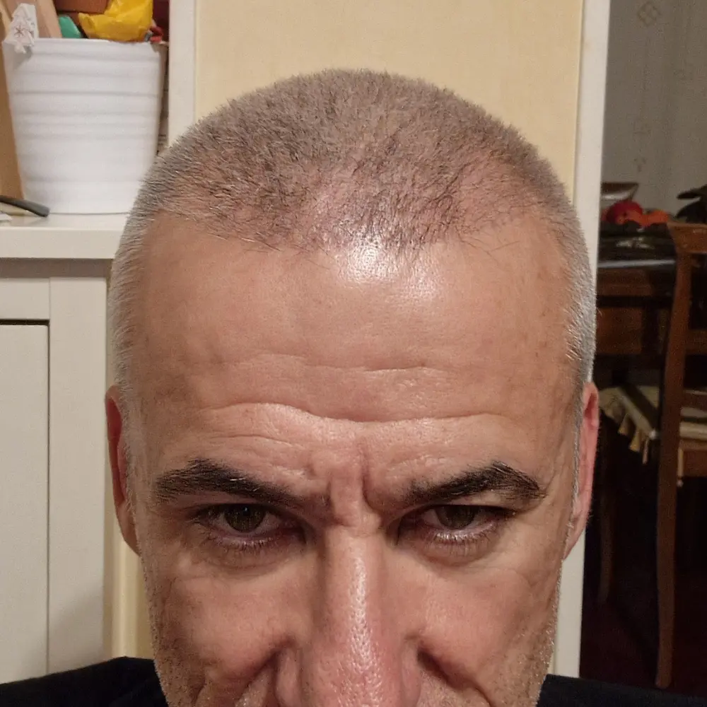Frontale post-intervento