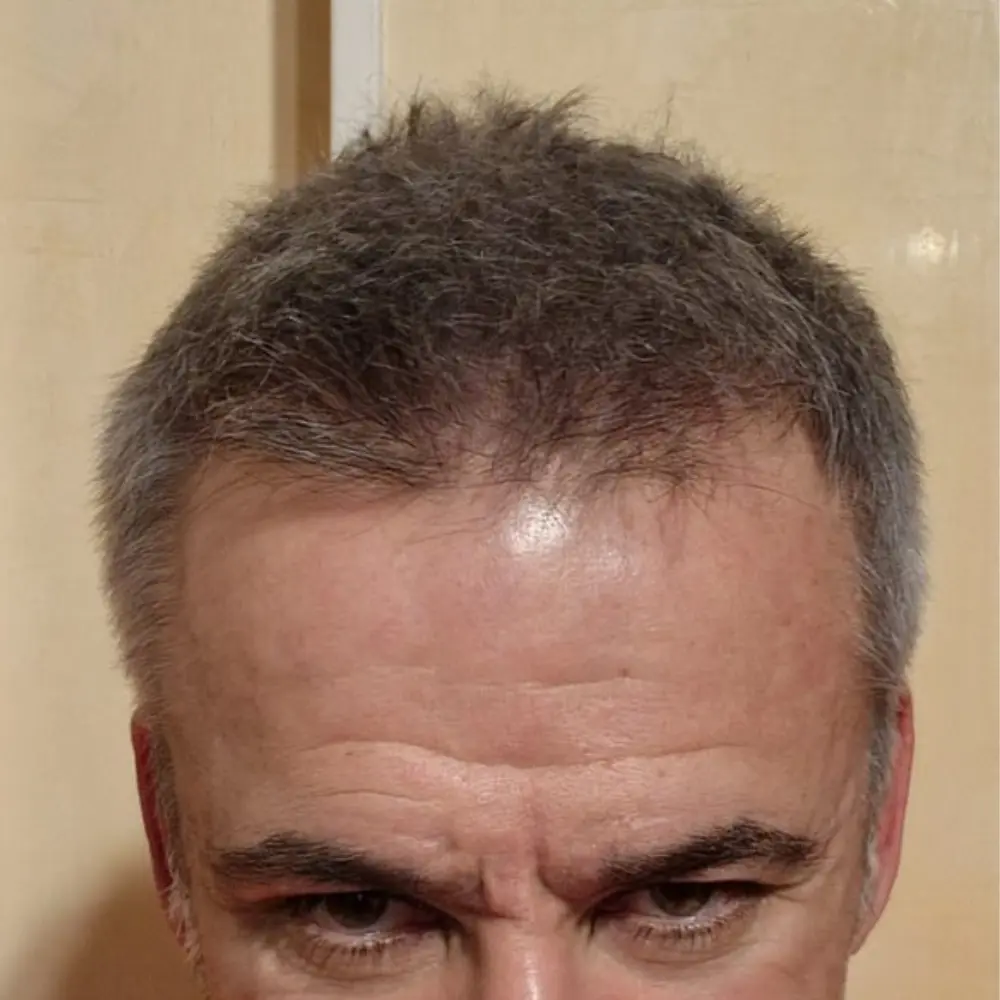 Frontale prima